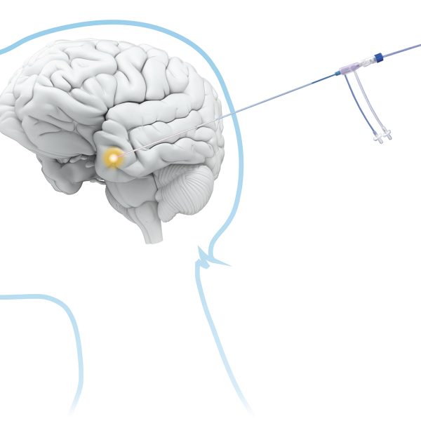 NHS launches laser beam brain surgery